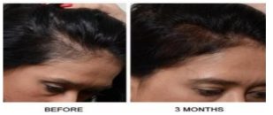 Is Platelet-Rich Plasma the Right Hair Restoration Option for You in New Jersey?