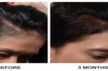 Is Platelet-Rich Plasma the Right Hair Restoration Option for You in New Jersey?