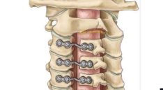Best Cervical Spine Surgeon in India Explains the Benefits of Personalized Surgical Planning