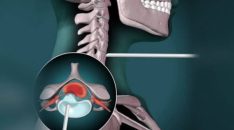 Endoscopic Cervical Spine Surgery Offers Faster Recovery for Patients in Kolkata