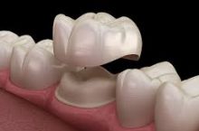 Trinity Dental @ Heathridge Offers the Right Dental Crowns